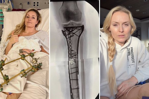 Lindsey Vonn opens up on the extent of her injuries.