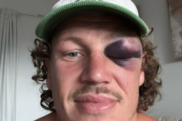 Kurt Mann’s black eye.