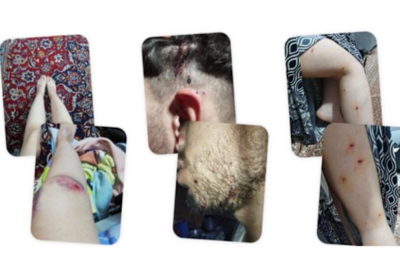 Photographs of apparent birdshot or buckshot wounds shared with an Iranian doctor in the United States by protesters who said they were fired upon by security forces in Iran. Blurring to graphic wound was applied by The New York Times.