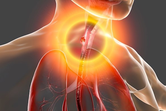 Proteomics International Laboratories ls launching its PromarkerEso oesophageal cancer test globally, backed by a top-tier clinical board of global gastrointestinal and cancer diagnostic experts.
