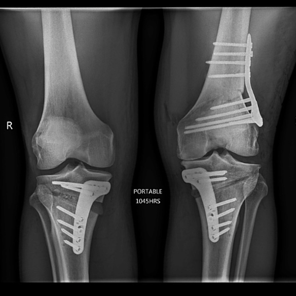 Nic White’s X-rays after his surgery.