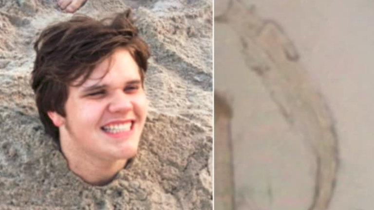 Michael Dumas, 17, got hookworm when his friends buried him in the sand at a Florida beach in June.