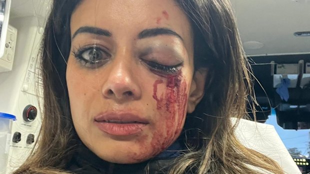 Hannah Thomas with a bruised and swollen eye, and bloodied face in an ambulance after being arrested during a protest in Belmore on Friday.
