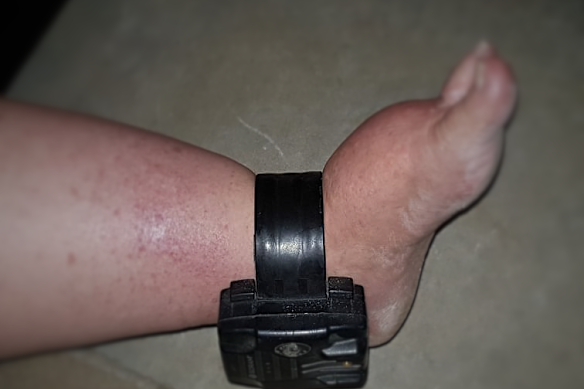 The ankle monitor that Taxpayer A was forced to wear for nine months as part of her bail conditions.