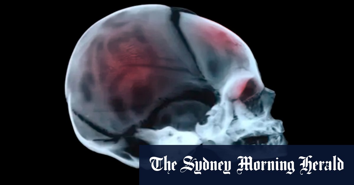 Is shaken baby syndrome convicting innocent people?