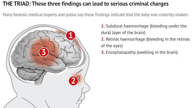 The signs forensic experts have relied on as evidence of shaken baby syndrome.