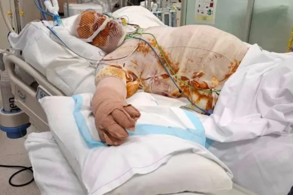 Jai Brebner is still in a critical condition after he was set on fire in Baldvis two weeks ago.