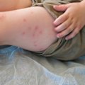 A measles outbreak is spreading across South Australia after a case was detected in a teenager from Brighton Secondary School.