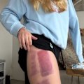 Leah Stewart, who survived a shark attack earlier this year, has said an attempted skin graft on her leg has failed.