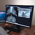Melbourne researchers have developed an AI-based tool to detect the risk of breast cancer.