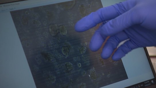 A world-first trial in Melbourne hopes to revolutionise how bowel cancer and other diseases are treated.