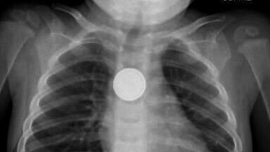 Australian medical professionals have issued an urgent warning following a sharp rise in the number of young children swallowing button batteries. 