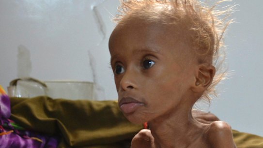 Salem, 5, who suffers from malnutrition, sits on a bed at a hospital in the port city of Hodeidah, southwest of Sanaa, Yemen, in September. 
