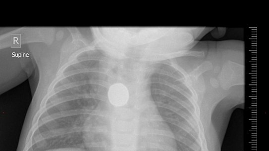Chest X-ray of a nine-year-old.