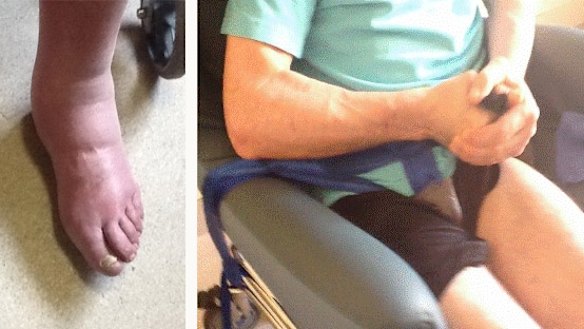 John Daly's swollen feet; strapped to a wheelchair.