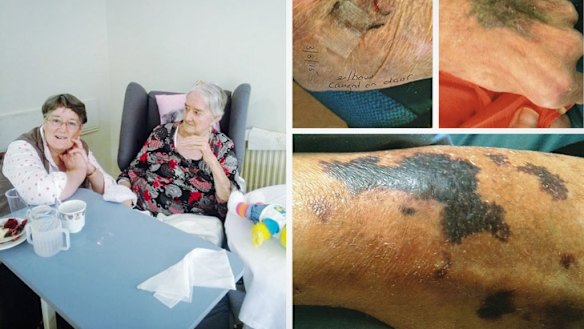 Helen Hardy with her mother, June, and bruises she sustained while in aged care.