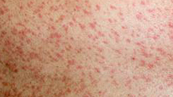 Infected tourist sparks measles alert for major Victorian destinations