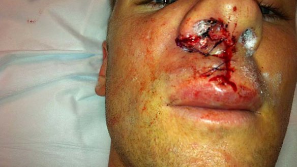 Shane Smeltz's wife Nikki posted a photo of the Perth's star striker's injured face on Twitter.