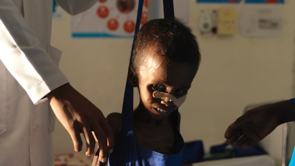 Being weighed. Niman Adan Gabush, 2, is a severe malnutrition case at Hargeisa Group Hospital in Somaliland.