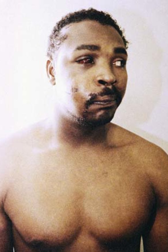 This photo of Rodney King was taken three days after his videotaped beating in Los Angeles on March 6, 1991.