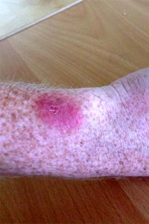 Fitbit Force causing rashes, sores in some users