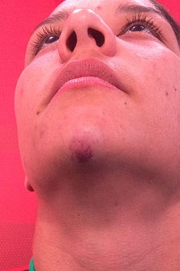 Bruised: Sam Kerr after the incident.