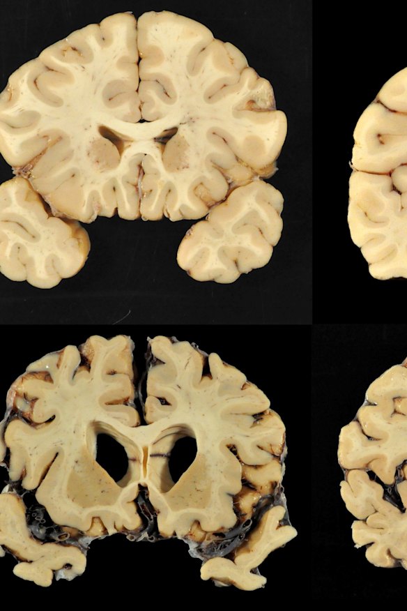 This combination of photos provided by Boston University shows sections from a normal brain, top, and from the brain of former University of Texas football player Greg Ploetz.
