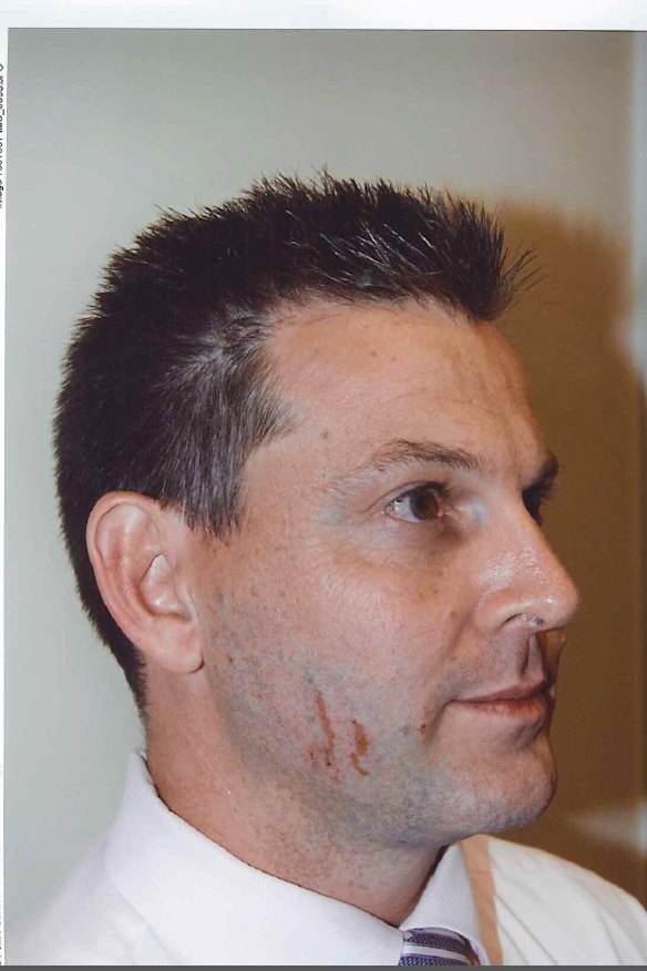 Scratches on Gerard Baden-Clay's face  provided crucial evidence during his murder trial.