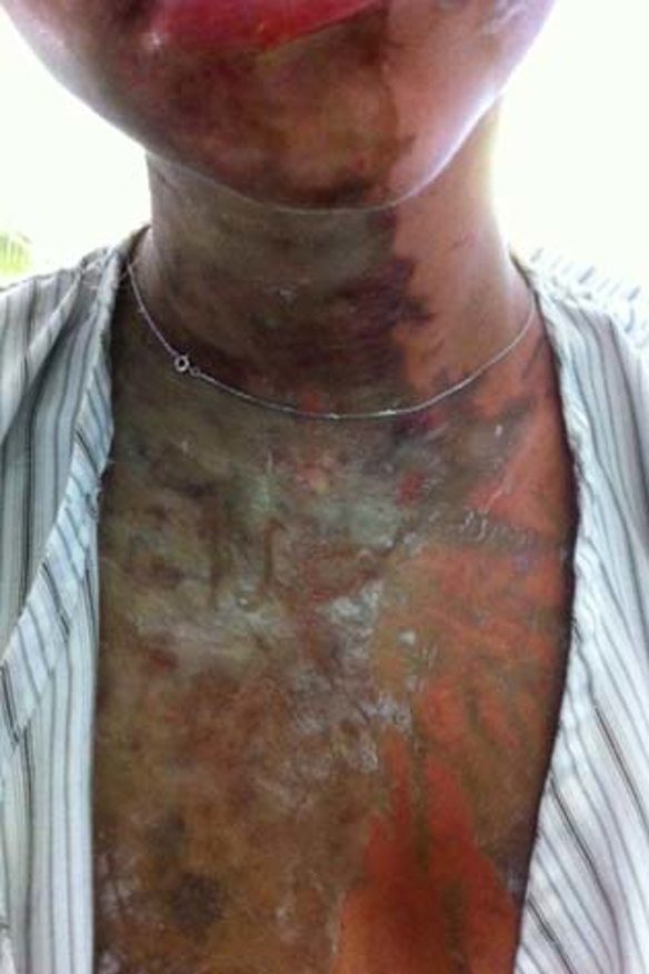 Radical Muslims suspected in acid attack on British teens