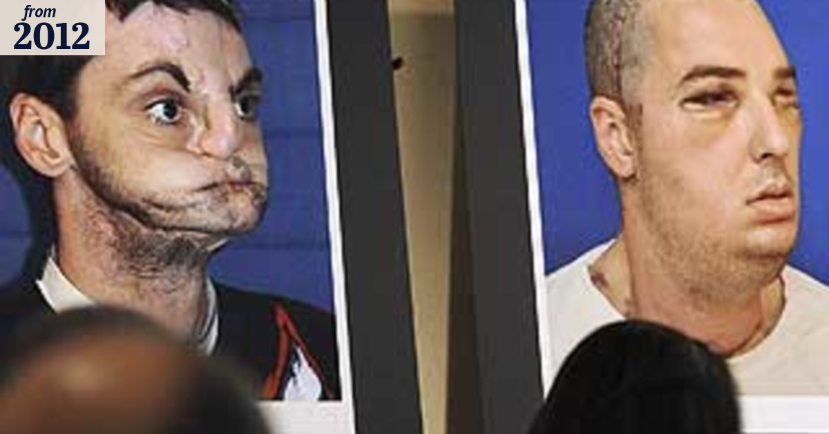 Gun victim's new face ends years as a recluse