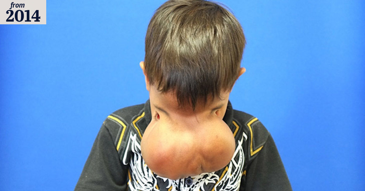 Surgery transforms boy's face