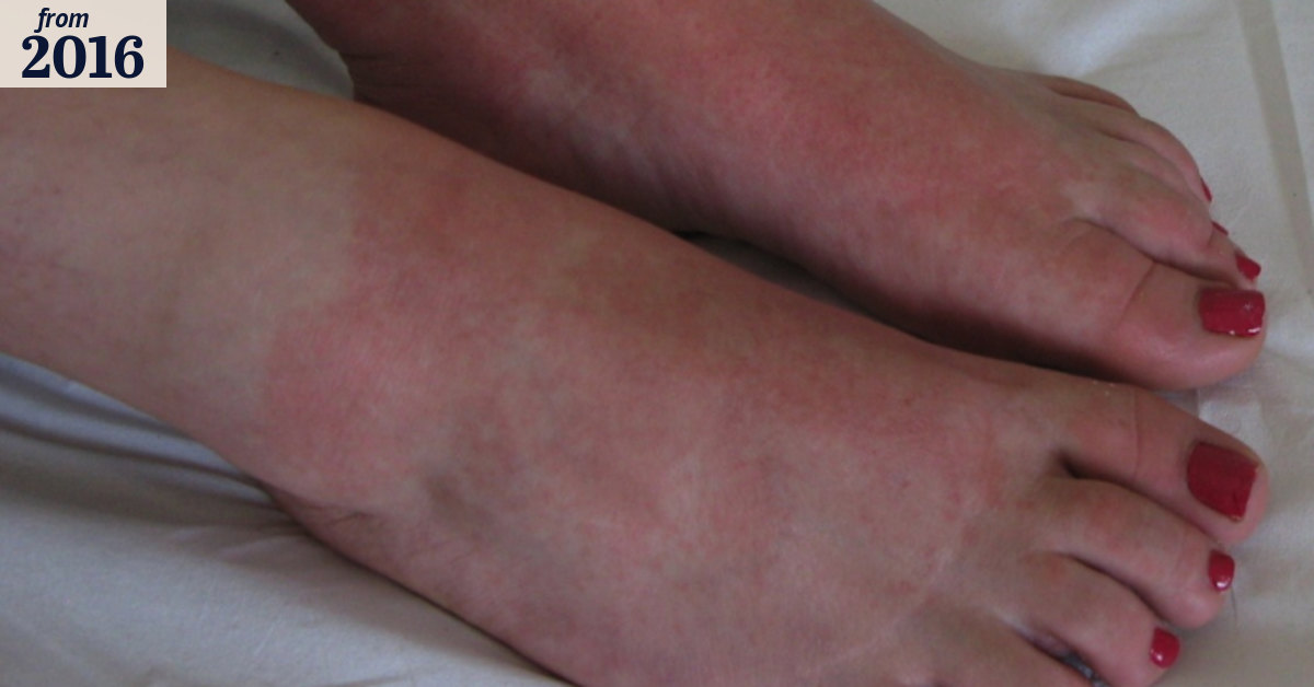 Protective compound added to skin cells helps body fight eczema ...
