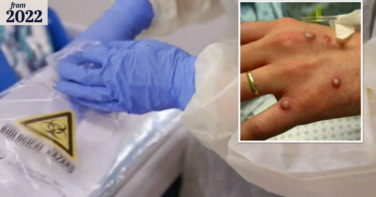 Second monkeypox case recorded in Western Australia