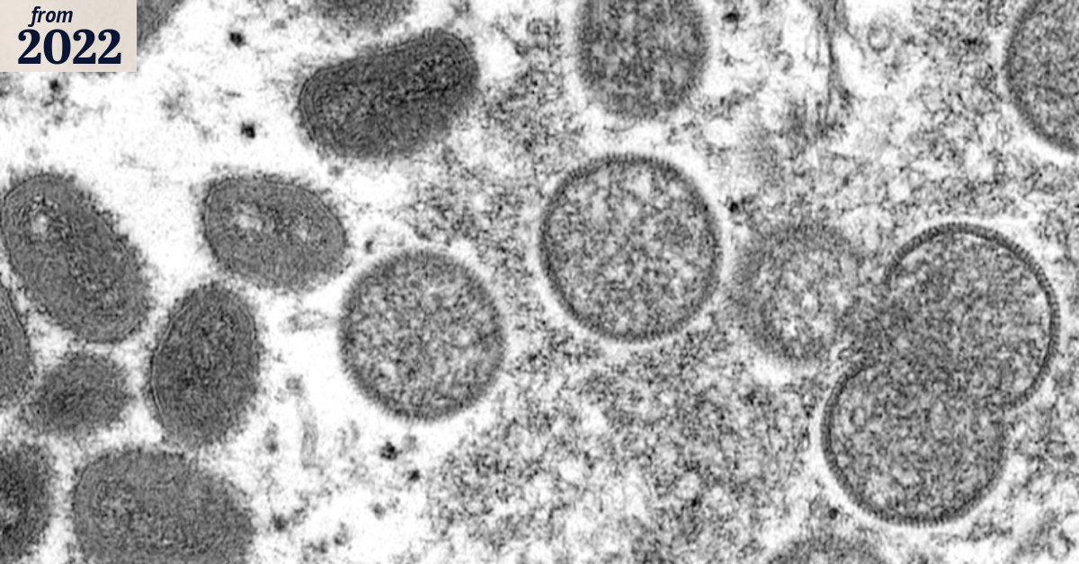 Monkeypox case confirmed in NSW