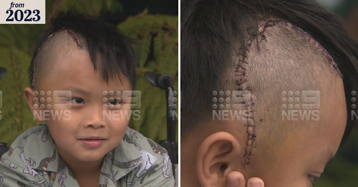 Seven year-old undergoes brain surgery after violent attack