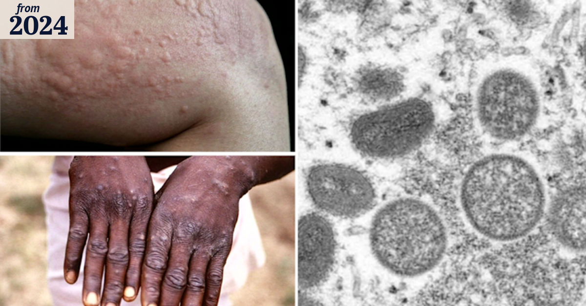 Africa declares public health emergency following Mpox outbreak