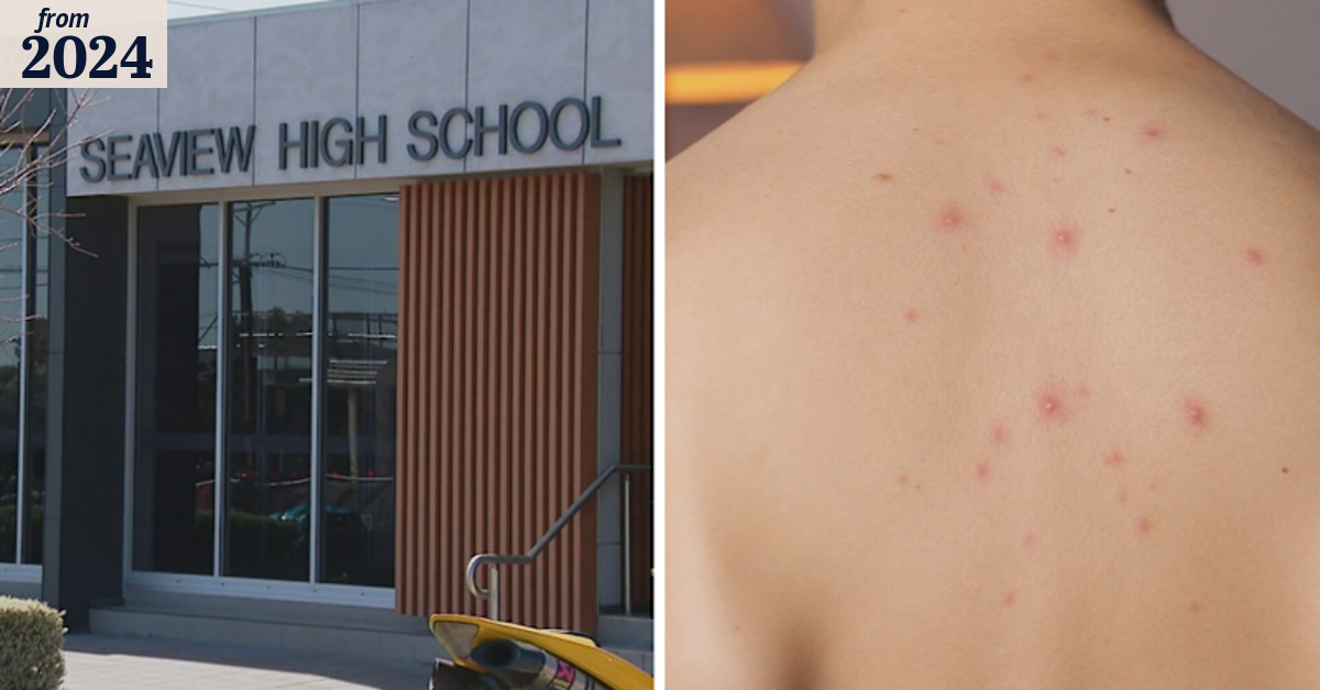 Adelaide hit with chicken pox outbreak